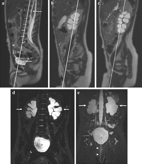 Rapid T2 W Magnetic Resonance Urography Mru In A 23 Month Old Boy Download Scientific Diagram