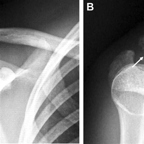 Plain Radiographs At Second Injury A Ap View And B Axial View