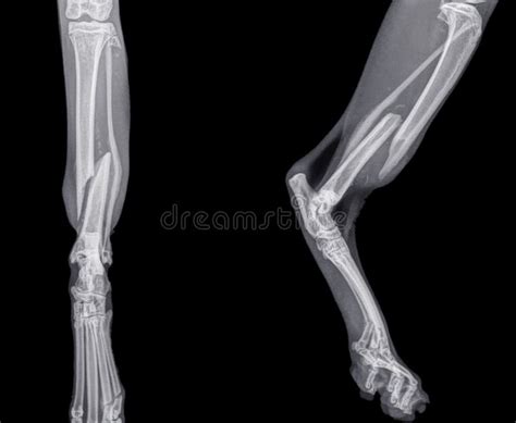 495 Fracture Tibia Fotos Kostenlose Und Royalty Free Stock Fotos Von