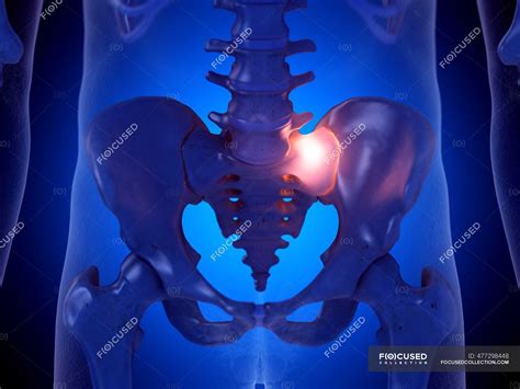 Painful Sacroiliac Joint Computer Illustration Anatomical Artwork