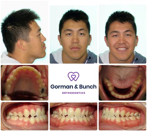 Invisalign Before And After Stories With Our Patients Gorman And Bunch