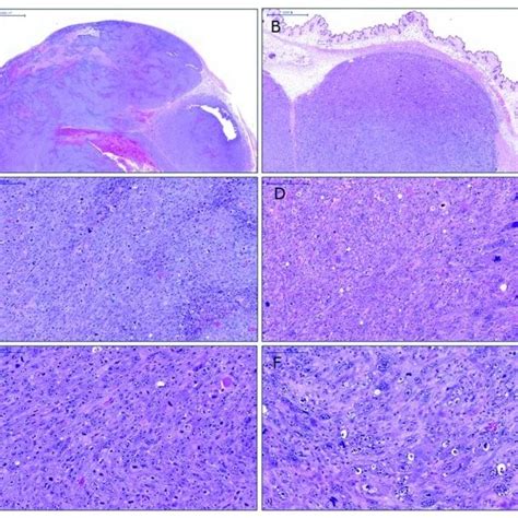 Microscopic Images Of A Cut Surface Of Each Tumor In H E Staining A