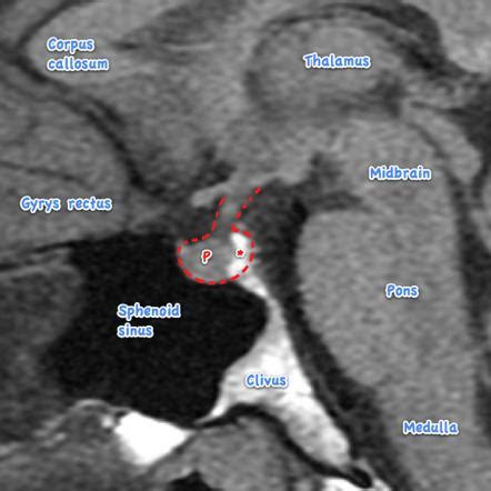 Pituitary Gland Anatomy Mri