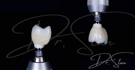 Coroana Implant Dentar Pret Si Tipuri