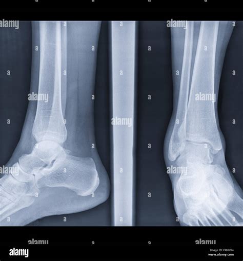 Anatomie des fibulaknochens Fotos und Bildmaterial in hoher Auflösung