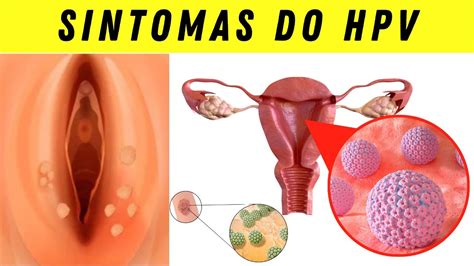 SINTOMAS DA HPV E QUAL TRATAMENTO MAIS ADEQUADO YouTube