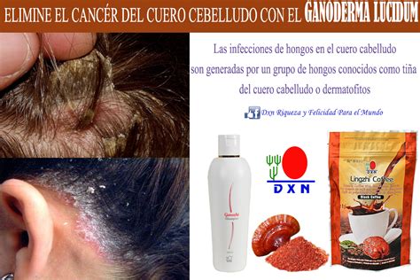 Elimine El C Ncer Del Cuero Cabelludo Con El Ganoderma Lucidum Dxn