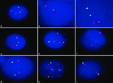 Fluorescence In Situ Hybridization Analysis Showed Positive Status For