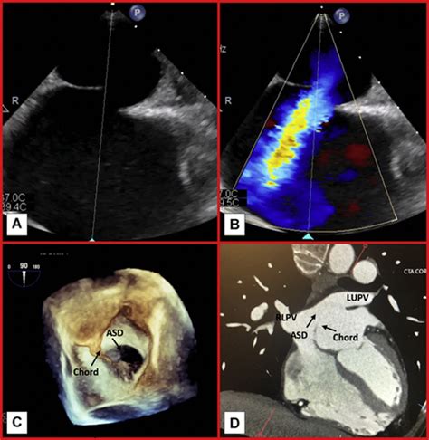 Successful Transcatheter Closure Of A Rare Malaligned Atrial Septal