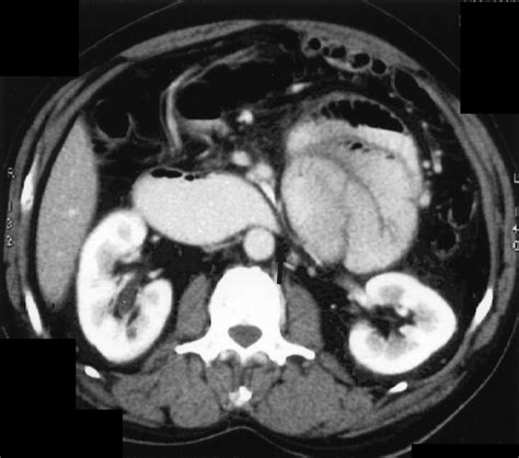 Ct Findings Of An Abdominal Cocoon Ajr