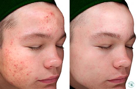 Chemical Peels Before and After photo gallery