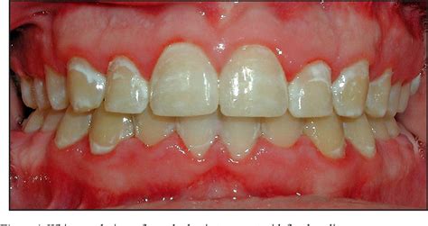 Figure From Prevention And Treatment Of White Spot Lesions During And