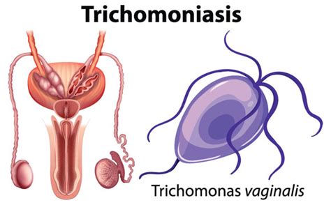 Trichomonas Vaginalis