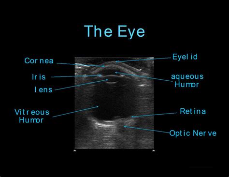 Ocular Ultrasound Vitreous Hemorrhage