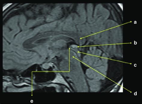 Pineal Gland Mri