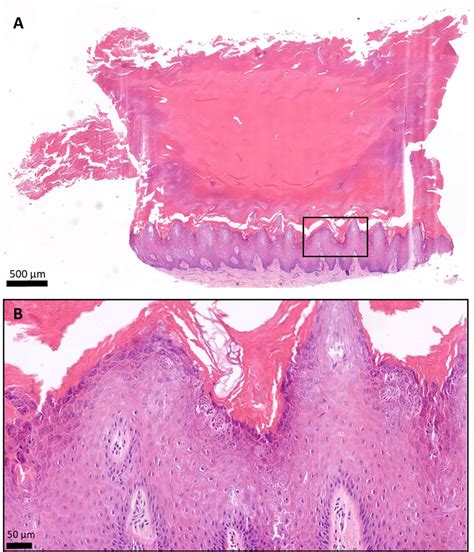 Histology of the plantar keratoderma of the patient, hematoxylin and... | Download Scientific ...