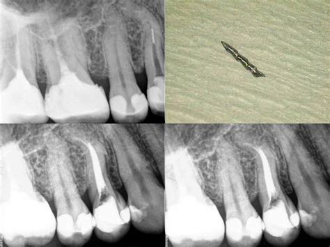 Leczenie Kana Owe Pod Mikroskopem Warszawa Moje Prace Endodontyczne