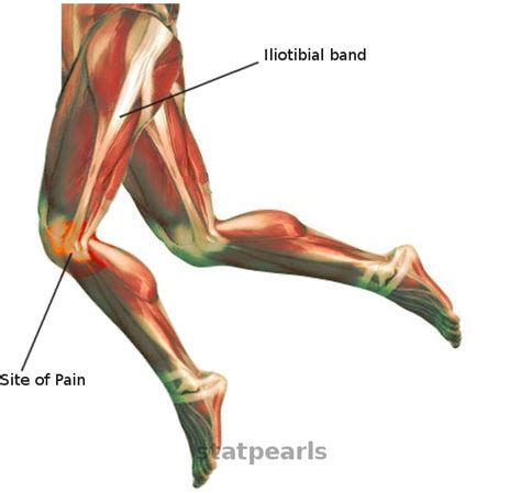 Iliotibial Band Friction Syndrome StatPearls NCBI Bookshelf