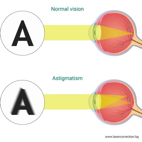 Astigmatism Causes Symptoms Treatment