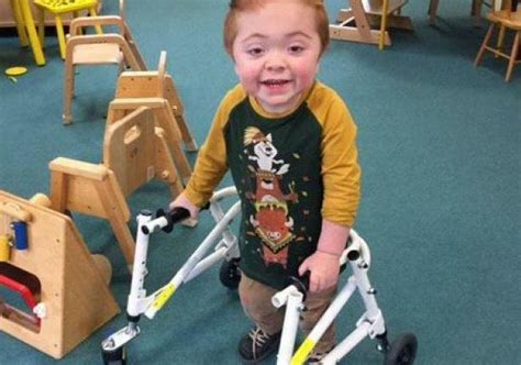 Hurler S Syndrome Causes Treatment And Photos