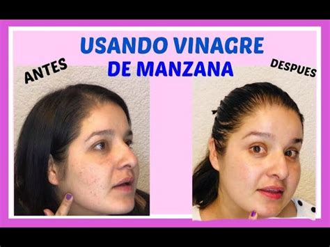 Como Usar El Vinagre De Manzana Para La Cara DonComo