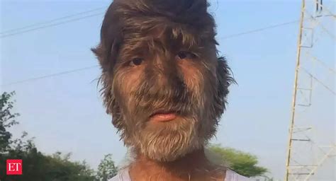 Werewolf Syndrome India Werewolf Syndrome Mp Teenager Shares His