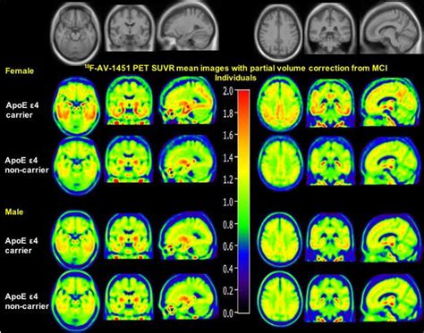 Alzheimers Disease Sex Affects Tau Accumulation In The Brain