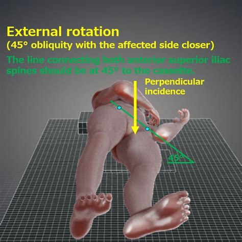 Hip Joint Oblique View Judet Method Teufel Method False Profile View