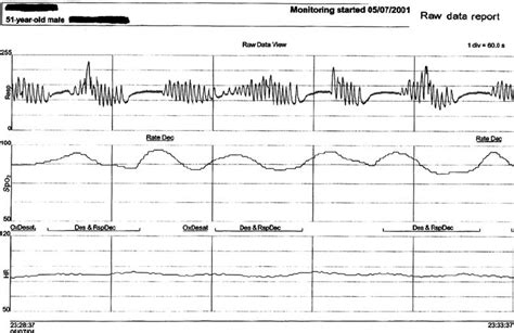 Cheyne Stokes Breathing Pattern