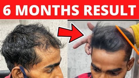 Case Study Explaining The Best Hair Transplant Result In Just 6