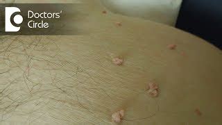 Genital Skin Tags In Men