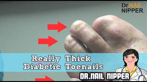 Really Thick Diabetic Toenails Dr Nail Nipper Youtube