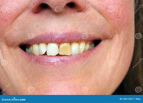 Stained Tooth Stock Image Image Of Happy Closeup Lips