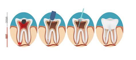 root canal sequence transparent abq dental associates