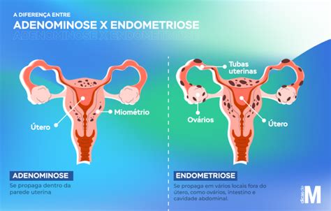 Adenomiose O Que Causas E Tratamentos