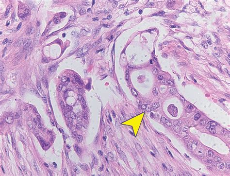 Pancreatic Ductal Adenocarcinoma And Its Variants Pearls And Perils