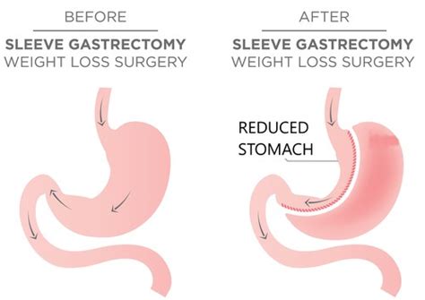 Bariatric surgery before and after - healthfitnesspodium