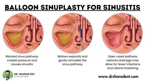 Discover The Benefits Of Balloon Sinuplasty For Sinusitis … Flickr