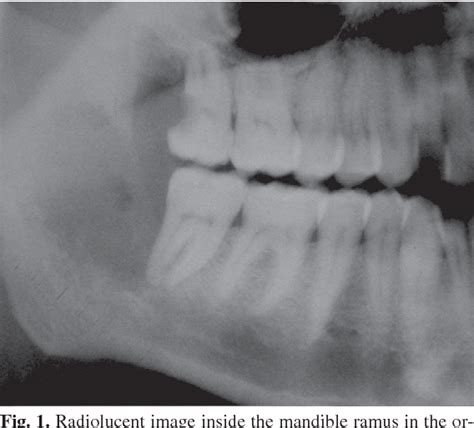 Figure 1 From Primary Intraosseous Carcinoma And Odontogenic Cyst