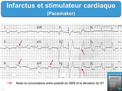 D Finitions Page Sur E Cardiogram