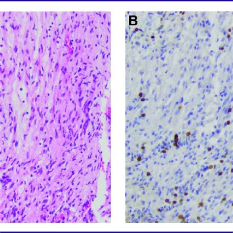 Hematoxylin And Eosin Staining A Of Cyst Wall Showing Myelinated And