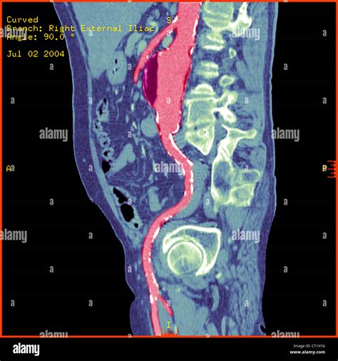 Abdominal Aorta Aneurysm Scan Stock Photo Alamy