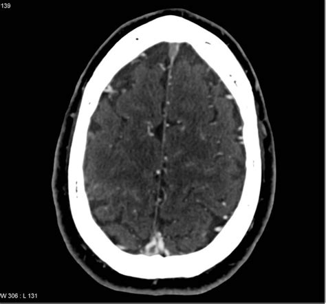 Cerebral Venous Sinus Thrombosis International Emergency Medicine