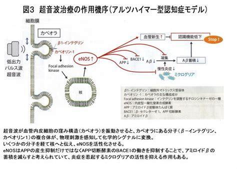 「低出力パルス波超音波治療によるアルツハイマー病への応用について（前編）」｜ 半蔵門スマイルライン矯正歯科