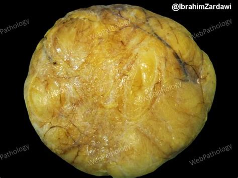 Lipoma Gross Pathology