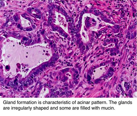 Pathology Outlines Adenocarcinoma Overview