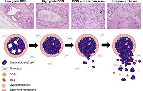 Invasive Ductal Carcinoma Diagram