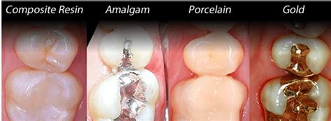 Porcelain dental filling - Family Dentistry on Brock