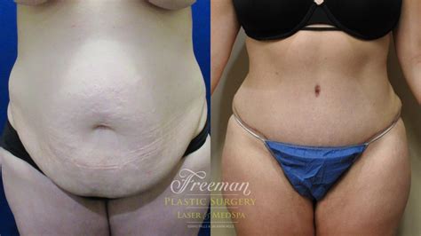 What Results Can You Expect From A Tummy Tuck Before And After Photos