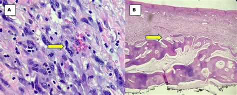 Histological findings of malignant fibrous histiocytoma (cont'd) All ...